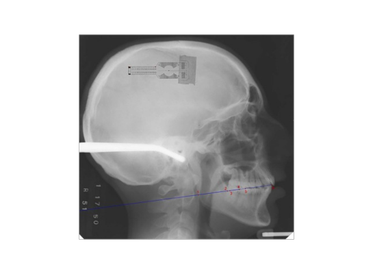X-ray image showing a human skull used for clinical orthodontic studies.