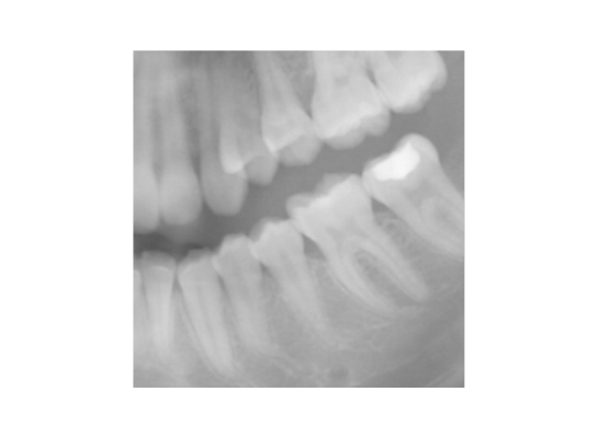 X-ray image showing the side view of a human jaw and teeth for DENTAGE orthodontic studies.